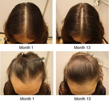 Real result sunburst hair growth 6 in1 shou bang Additional Hair Dense hair liquid